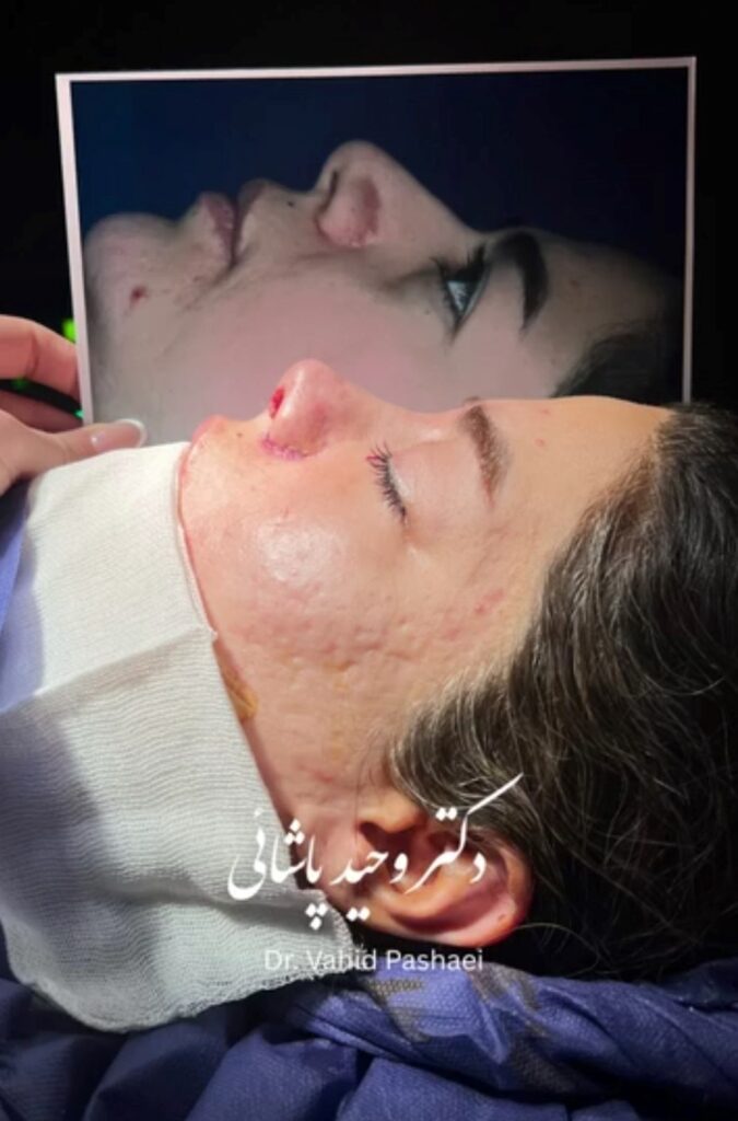 عمل بینی گوشتی
