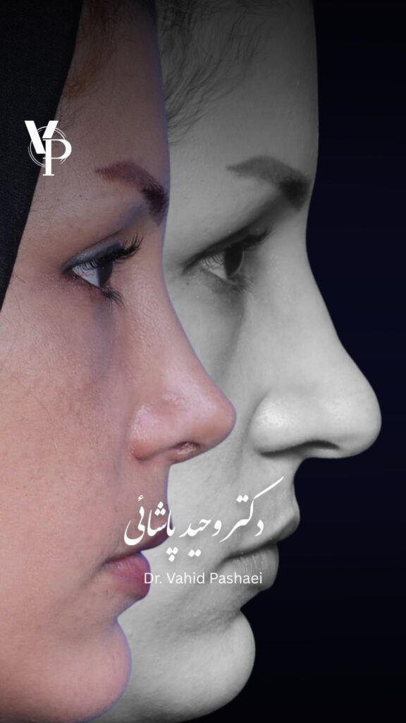 عمل بینی طبیعی