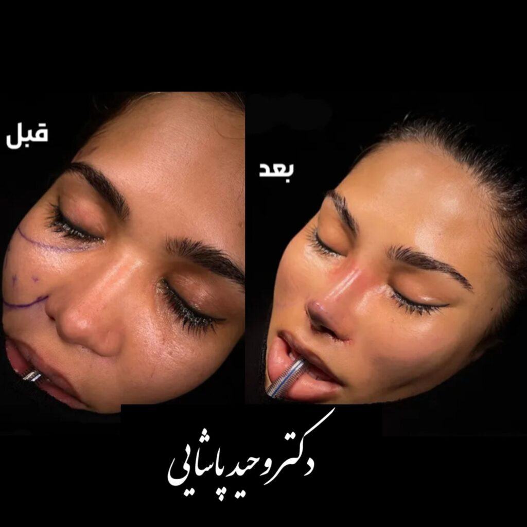 لیفت پیشانی