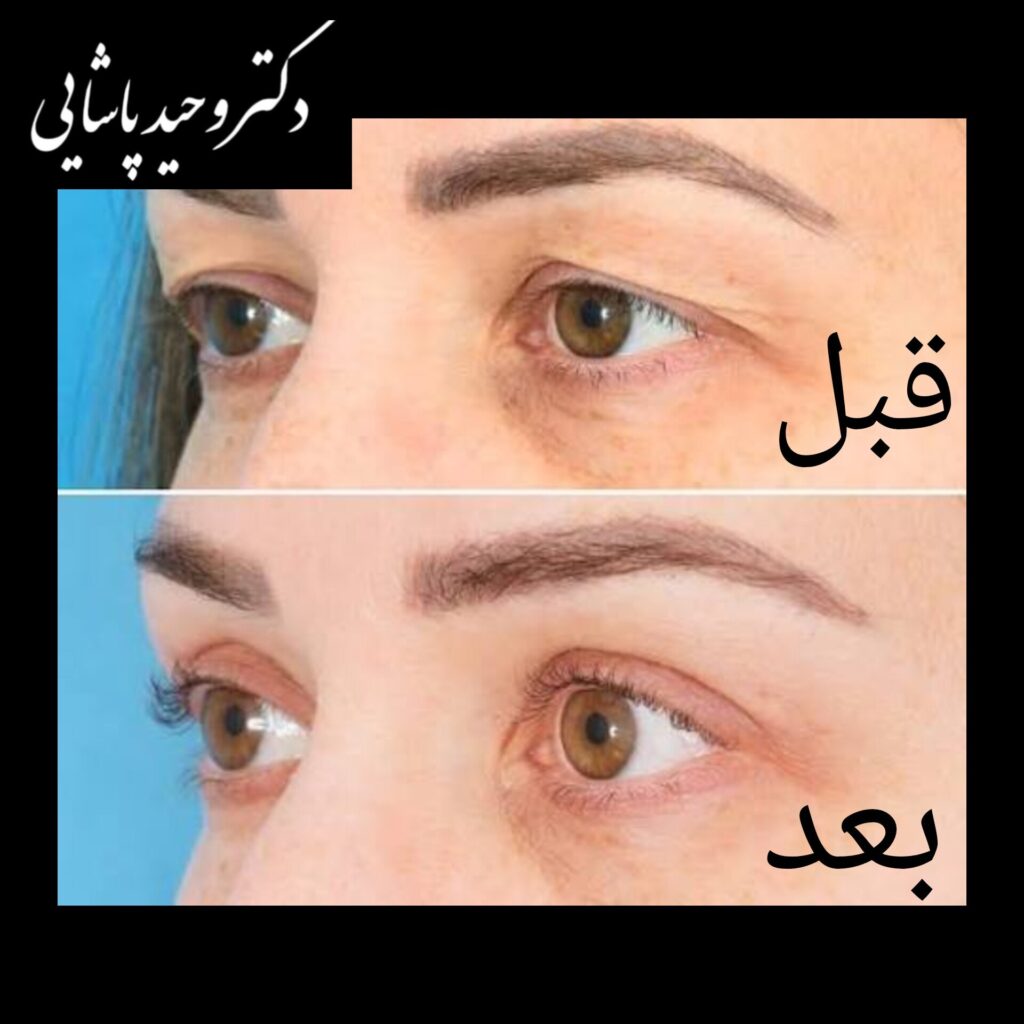 جراحی پف پلک