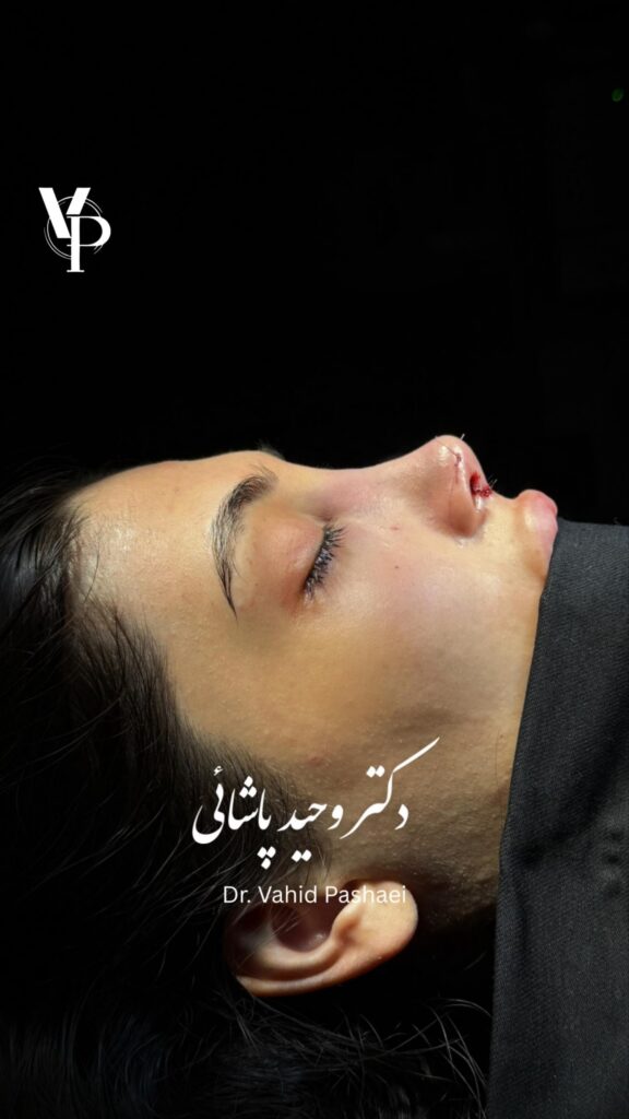 عمل بینی استخوانی