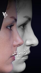عمل بینی طبیعی