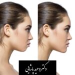 جنیوپلاستی