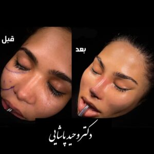 لیفت آندوسکوپیک