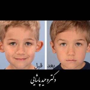 اتوپلاستی