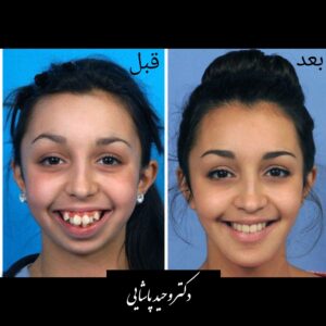 عمل فک پایین