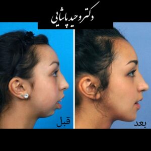 عمل فک بالا