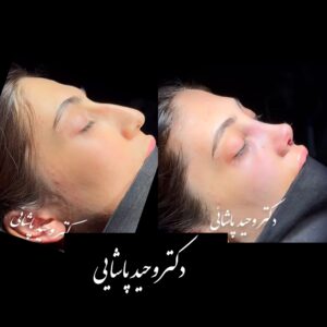 پلاستیک بینی